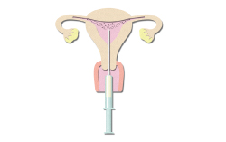 洗浄濃縮精子を子宮内に注入します